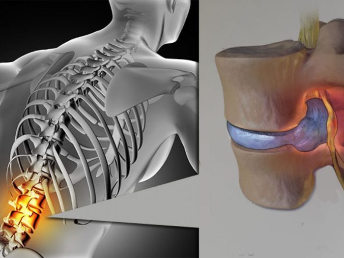 Kode icd hernia nukleus pulposus