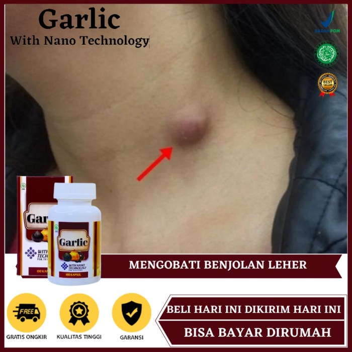 Obat Herbal Benjolan Di Leher